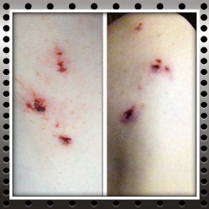 Left side is in the car right after the hike. Right side is the day after. And yes, I am just that pale! :P